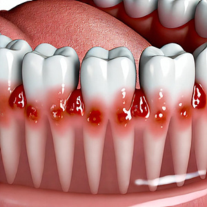 잇몸이 붓고 피가 계속 나요 구강 건강이 중요한 이유